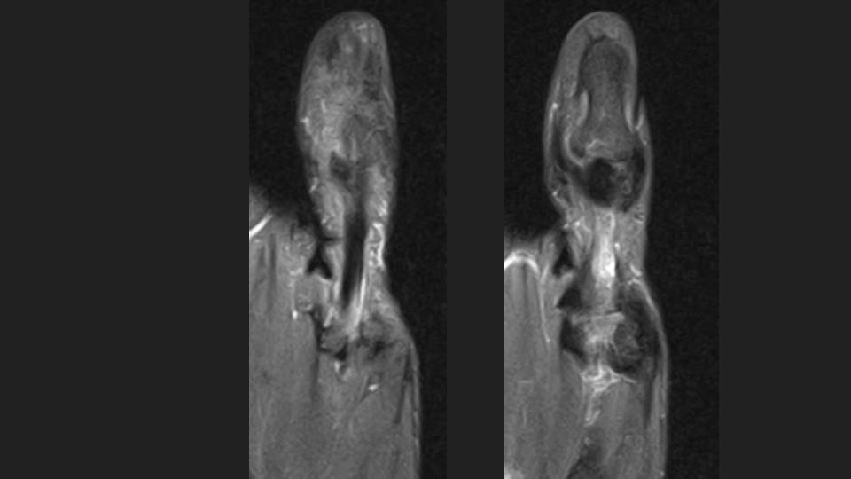 Figure 5 for case annular pulley of finger ( RID2435 )